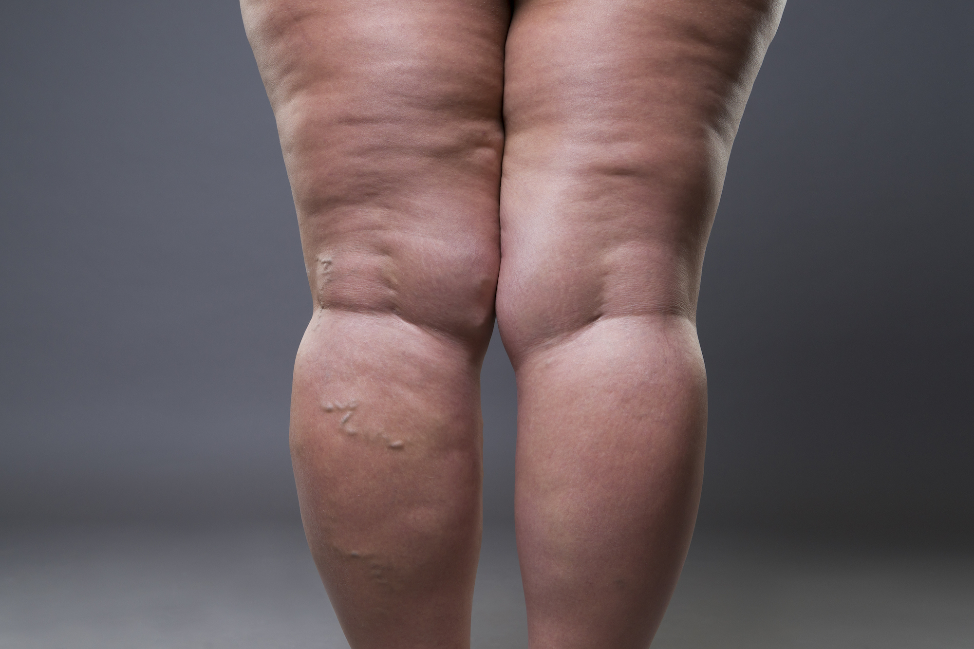 Varicose veins closeup fat female cellulite legs on a gray background