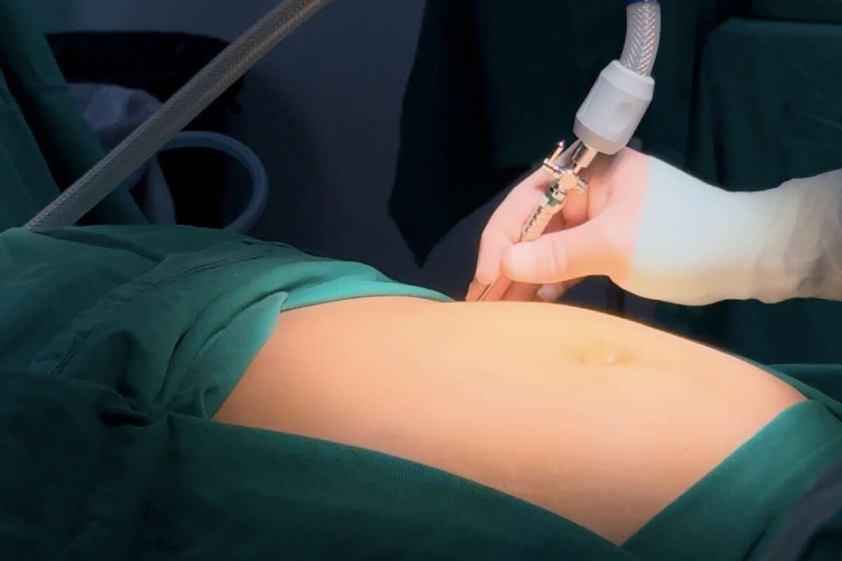 O Impacto da Cirurgia Bariátrica na Saúde Metabólica